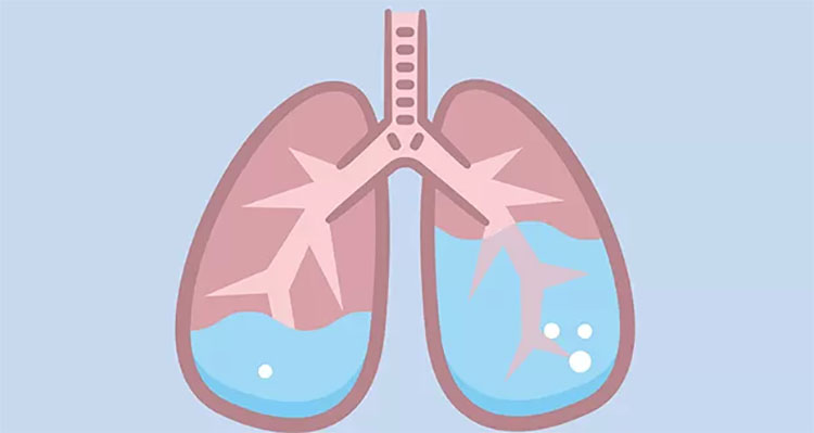 高海拔肺水腫預防與緩解